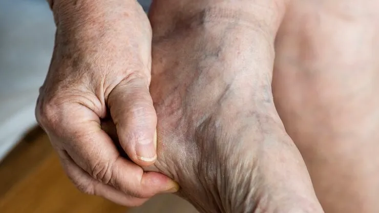 Swollen foot showing leg discomfort relieved by Flush Factor Plus