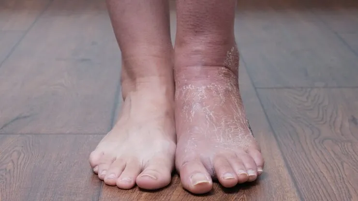 Close-up of dry, swollen feet supported by Flush Factor Plus supplement